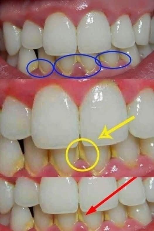 I Removed My Dental Plaque in 5 Minutes Without a Dentist Visit
